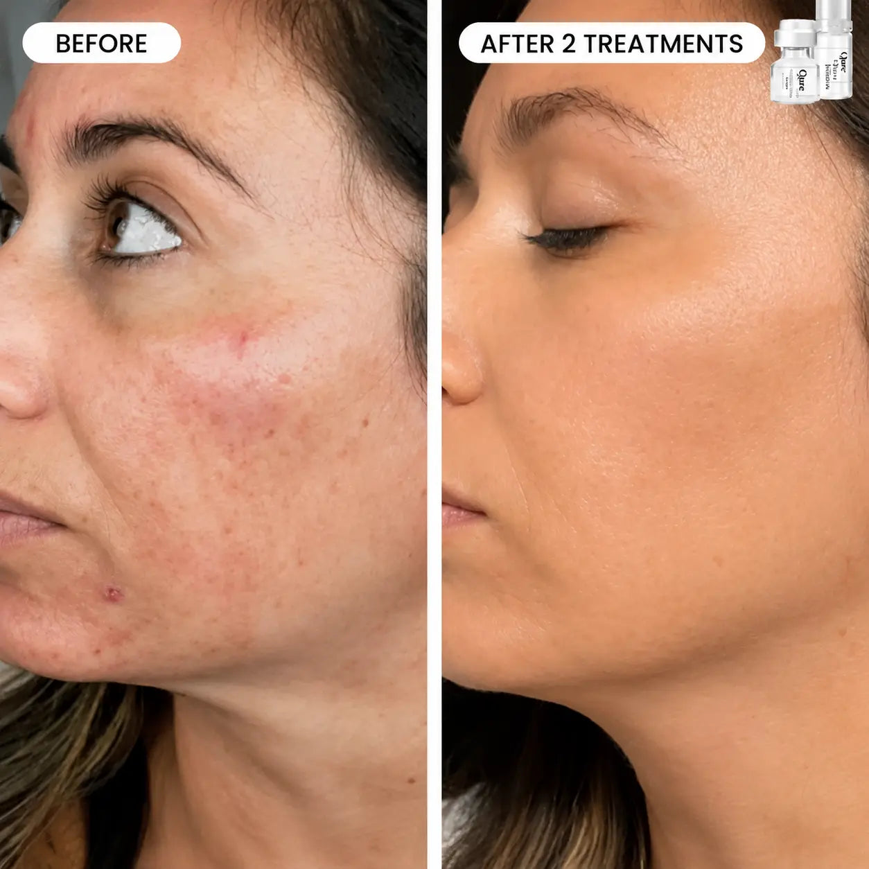 Refresh the look of dull skin with the Micro-Infusion Facial System