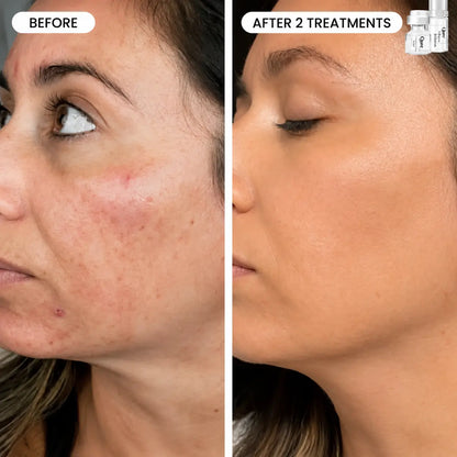 Refresh the look of dull skin with the Micro-Infusion Facial System